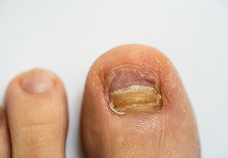 L4 na zerwany paznokieć