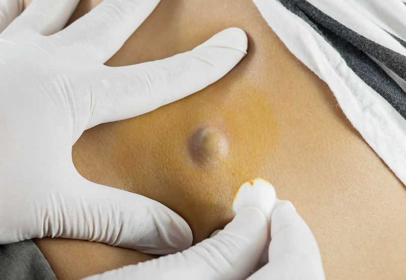 Usunięcie torbieli jajnika