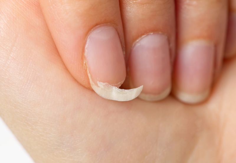 zerwany paznokieć