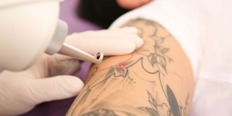 Gdzie usunąć tatuaż w Krakowie? Laserowe usuwanie tatuażu i makijażu permanentnego